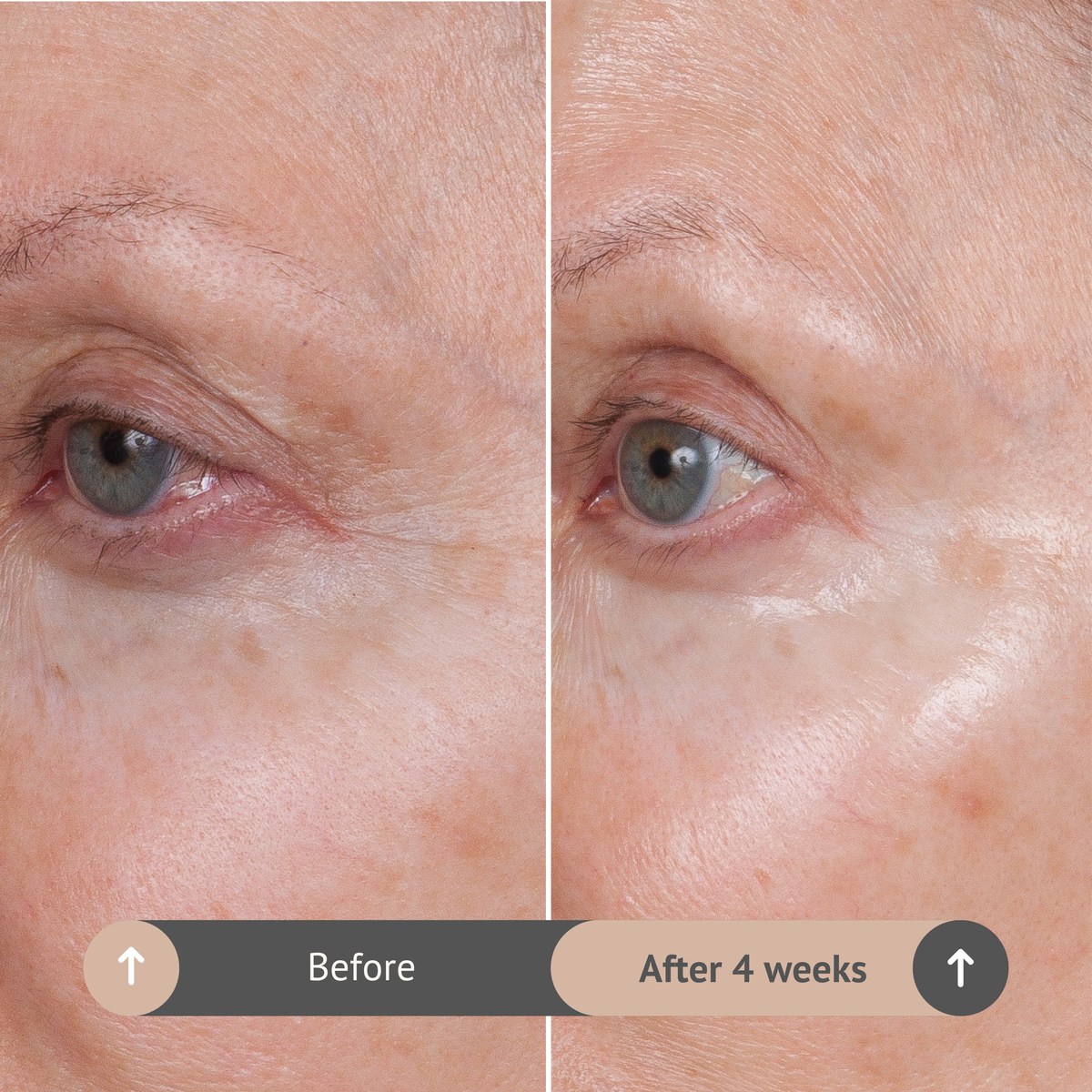 Before and after comparison of eye area skin texture with text indicating time elapsed.  Volumagen Eye Before/After 4 weeks.  Consult Beaute by Dr Terry Dubrow and Heather Dubrow.