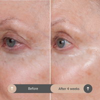 Before and after comparison of eye area skin texture with text indicating time elapsed.  Volumagen Eye Before/After 4 weeks.  Consult Beaute by Dr Terry Dubrow and Heather Dubrow.